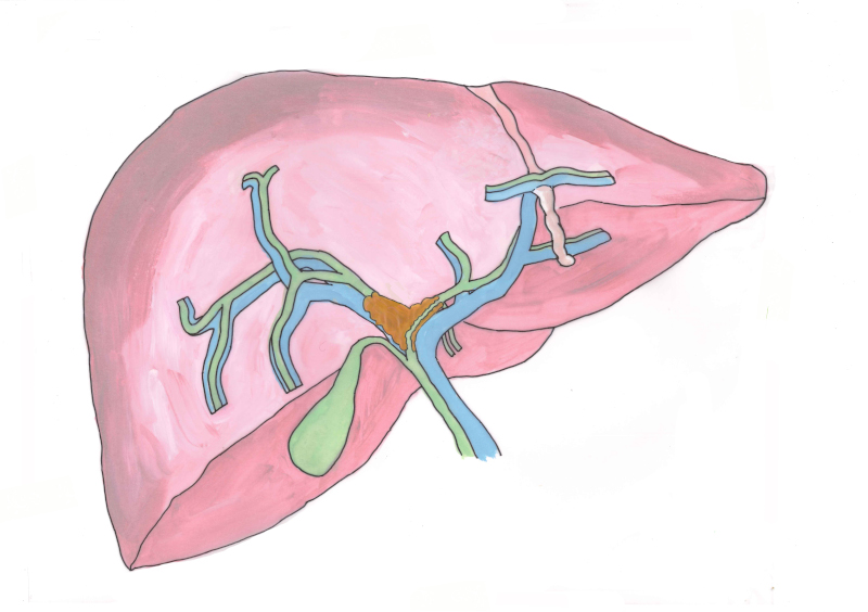 lever-met-cholangiocarcinoom