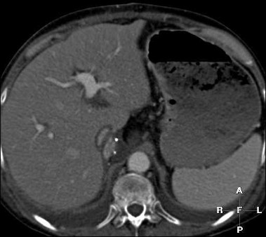 ct-scan-lever