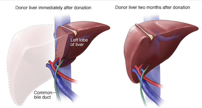 Donor lever