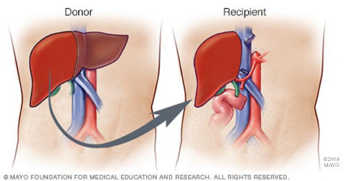 Donor lever