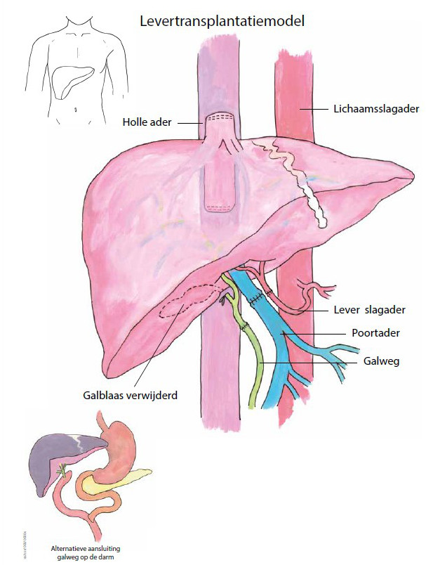 levertransplantatiemodel